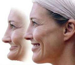 an image of before and after facial collapse